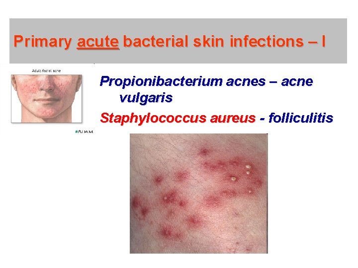 Primary acute bacterial skin infections – I Propionibacterium acnes – acne vulgaris Staphylococcus aureus