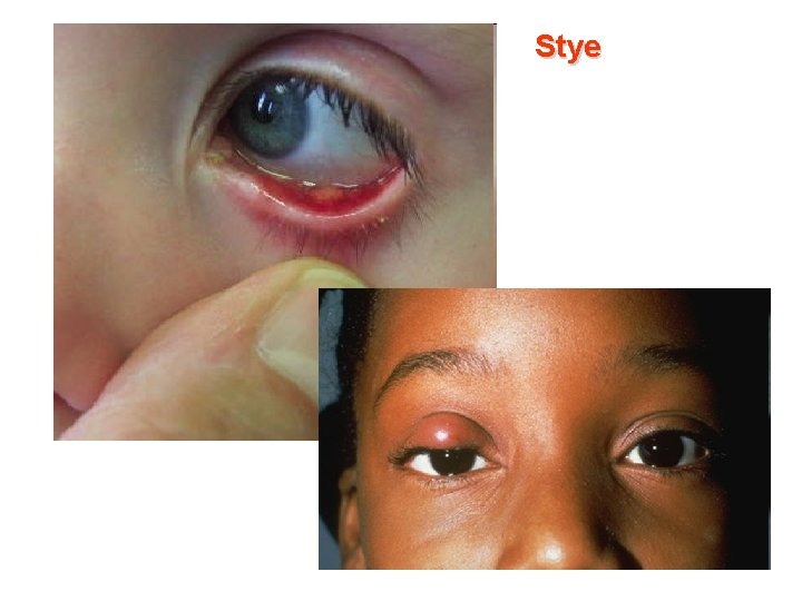 Stye 