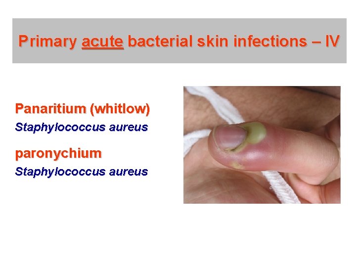 Primary acute bacterial skin infections – IV Panaritium (whitlow) Staphylococcus aureus paronychium Staphylococcus aureus