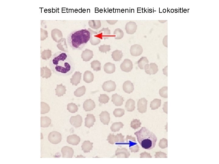 Tesbit Etmeden Bekletmenin Etkisi- Lokositler 