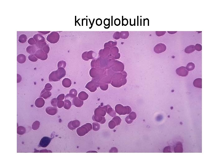 kriyoglobulin 
