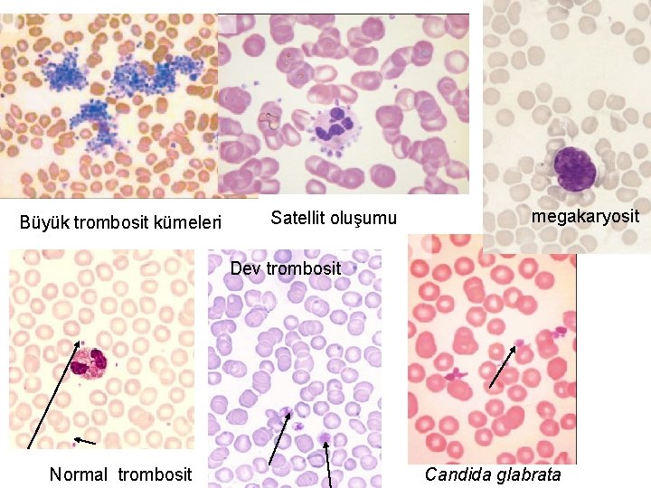 Büyük trombosit kümeleri Satellit oluşumu megakaryosit Dev trombosit Normal trombosit Candida glabrata 