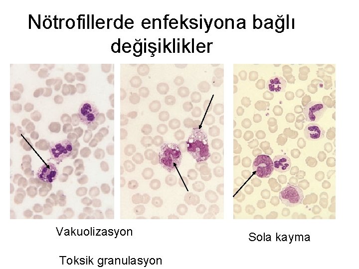 Nötrofillerde enfeksiyona bağlı değişiklikler Vakuolizasyon Toksik granulasyon Sola kayma 