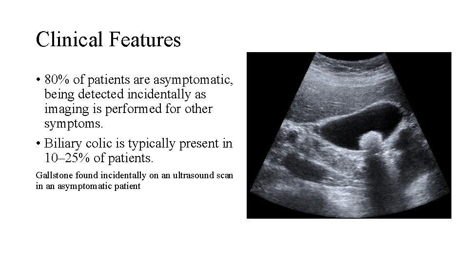 Clinical Features • 80% of patients are asymptomatic, being detected incidentally as imaging is