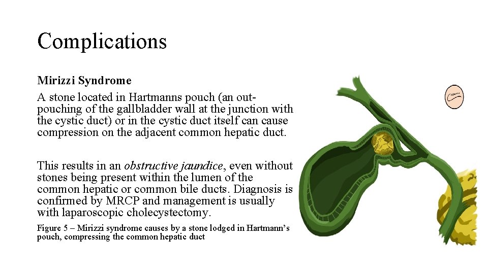 Complications Mirizzi Syndrome A stone located in Hartmanns pouch (an outpouching of the gallbladder