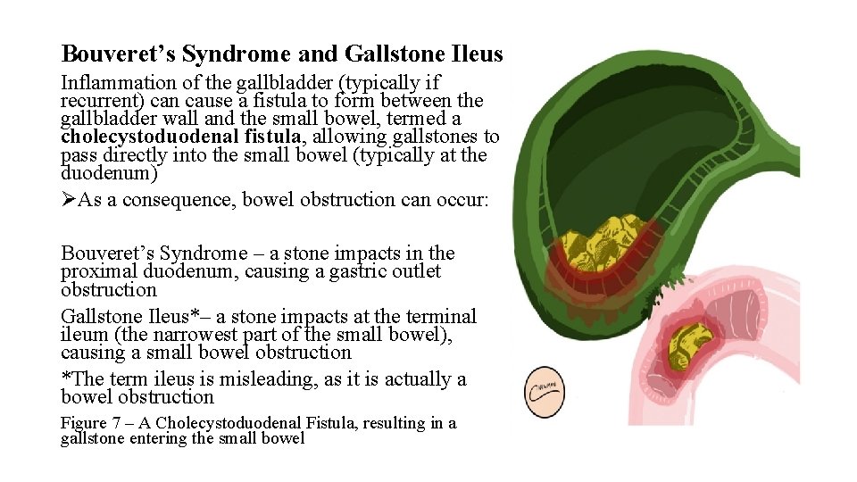 Bouveret’s Syndrome and Gallstone Ileus Inflammation of the gallbladder (typically if recurrent) can cause