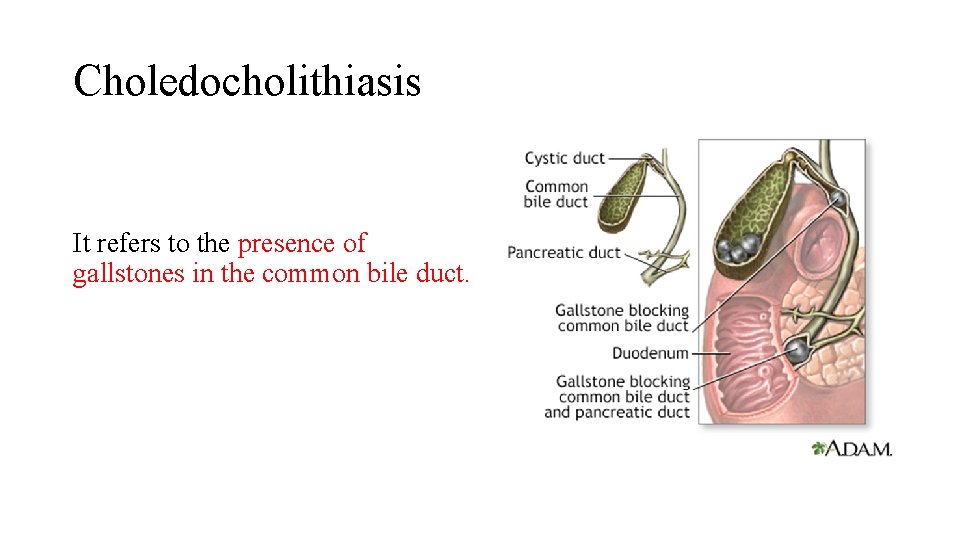 Choledocholithiasis It refers to the presence of gallstones in the common bile duct. 