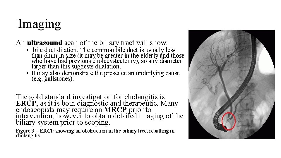Imaging An ultrasound scan of the biliary tract will show: • bile duct dilation.