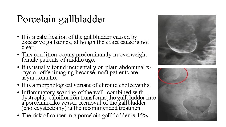 Porcelain gallbladder • It is a calcification of the gallbladder caused by excessive gallstones,