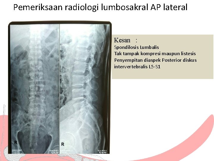 Pemeriksaan radiologi lumbosakral AP lateral Kesan : Spondilosis Lumbalis Tak tampak kompresi maupun listesis