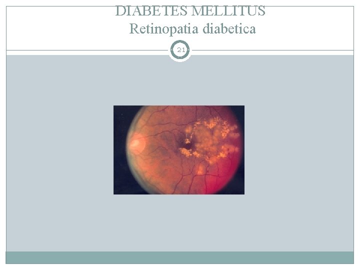 DIABETES MELLITUS Retinopatia diabetica 21 