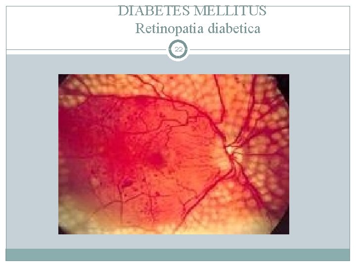 DIABETES MELLITUS Retinopatia diabetica 22 