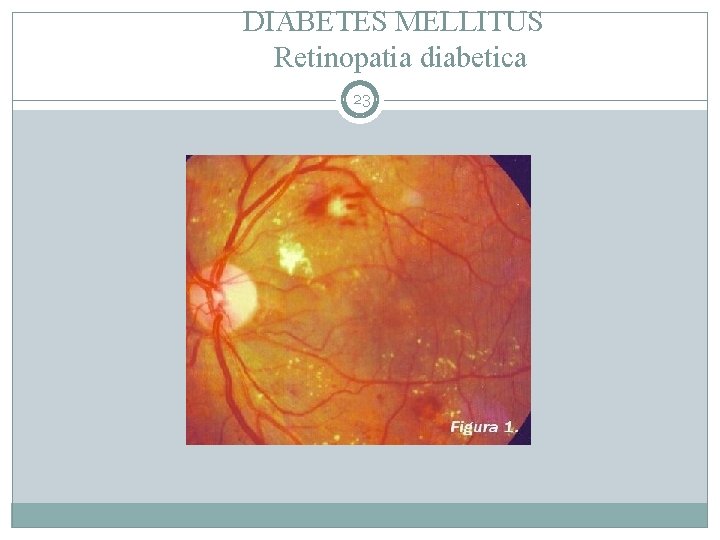 DIABETES MELLITUS Retinopatia diabetica 23 