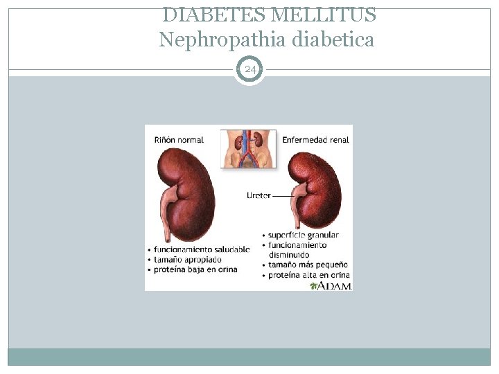 DIABETES MELLITUS Nephropathia diabetica 24 