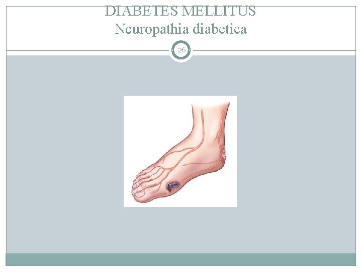 DIABETES MELLITUS Neuropathia diabetica 26 