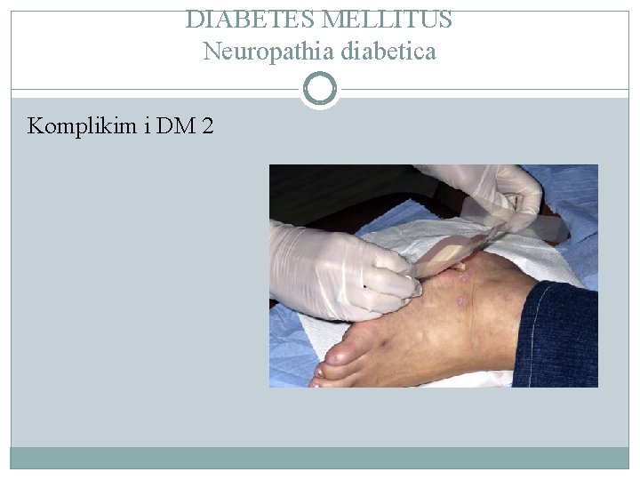 DIABETES MELLITUS Neuropathia diabetica Komplikim i DM 2 