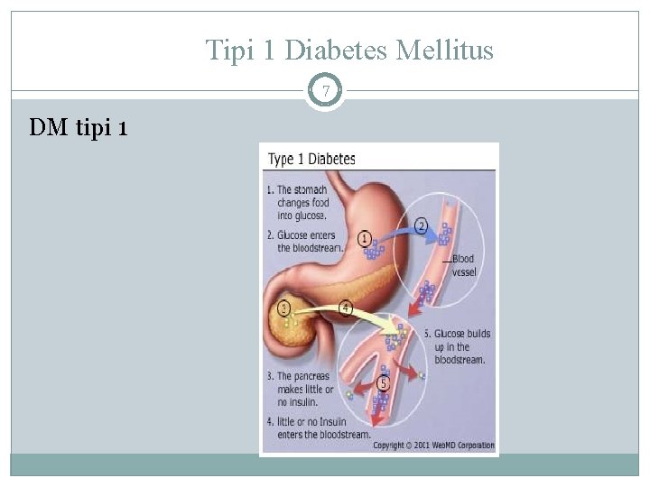 Tipi 1 Diabetes Mellitus 7 DM tipi 1 