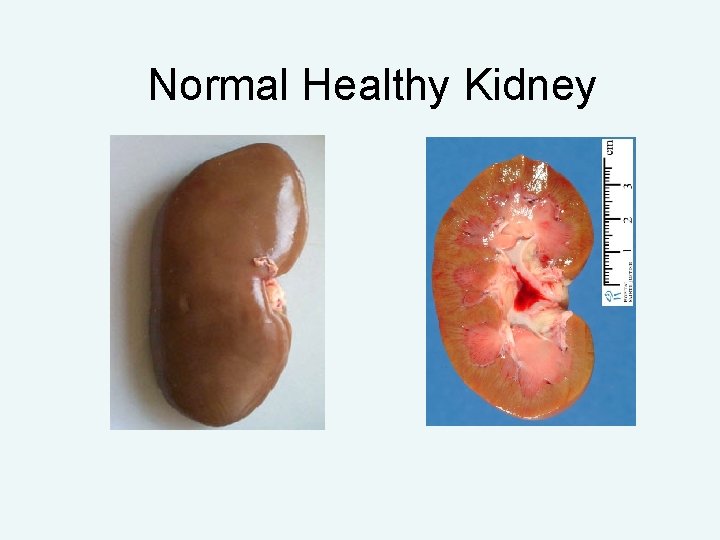 Normal Healthy Kidney 