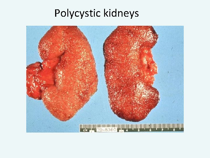 Polycystic kidneys 