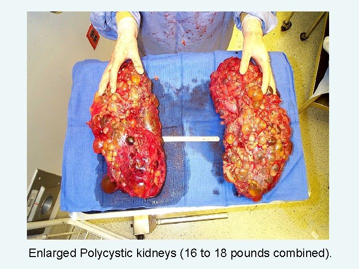Enlarged Polycystic kidneys (16 to 18 pounds combined). 