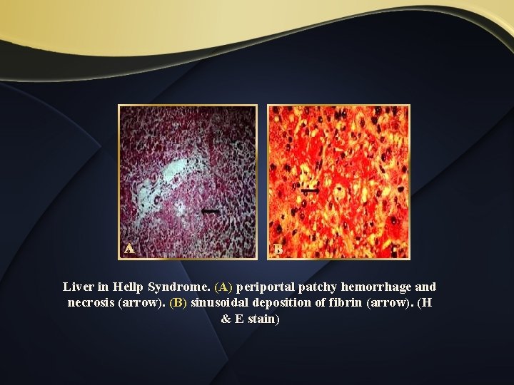 A B Liver in Hellp Syndrome. (A) periportal patchy hemorrhage and necrosis (arrow). (B)