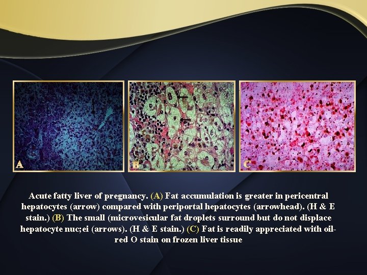 A B C Acute fatty liver of pregnancy. (A) Fat accumulation is greater in