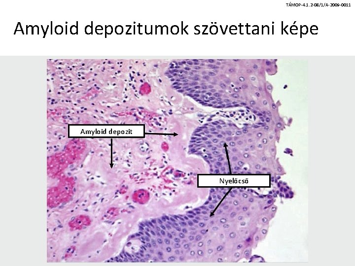 TÁMOP-4. 1. 2 -08/1/A-2009 -0011 Amyloid depozitumok szövettani képe Amyloid depozit Nyelőcső 