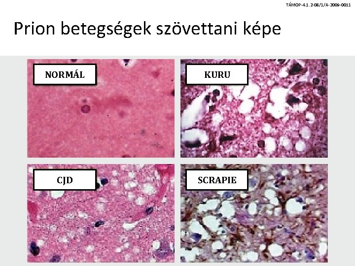 TÁMOP-4. 1. 2 -08/1/A-2009 -0011 Prion betegségek szövettani képe NORMÁL KURU CJD SCRAPIE 