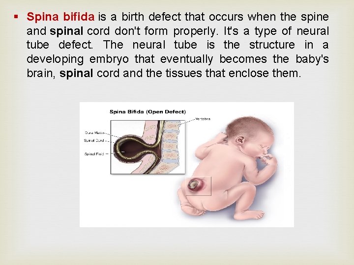 § Spina bifida is a birth defect that occurs when the spine and spinal