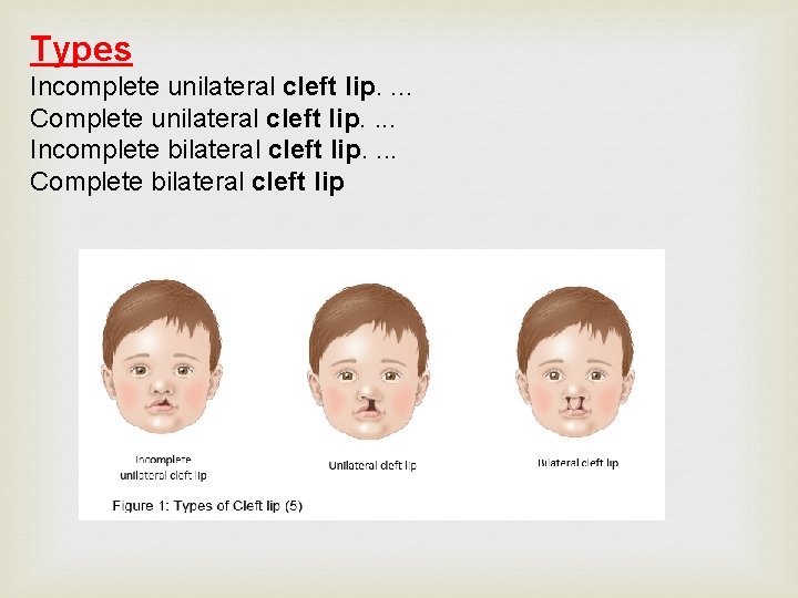 Types Incomplete unilateral cleft lip. . Complete unilateral cleft lip. . Incomplete bilateral cleft