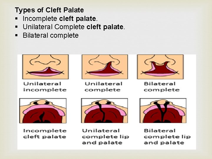 Types of Cleft Palate § Incomplete cleft palate. § Unilateral Complete cleft palate. §