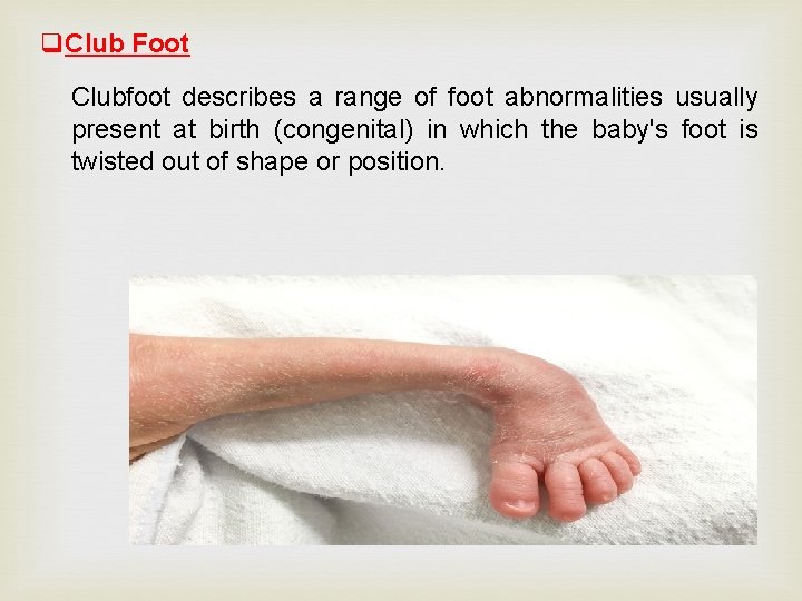 q. Club Foot Clubfoot describes a range of foot abnormalities usually present at birth