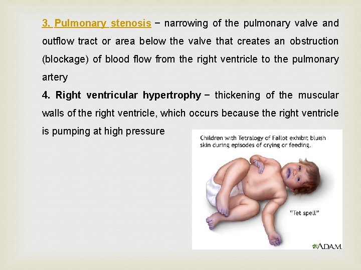 3. Pulmonary stenosis − narrowing of the pulmonary valve and outflow tract or area