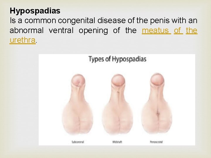 Hypospadias Is a common congenital disease of the penis with an abnormal ventral opening