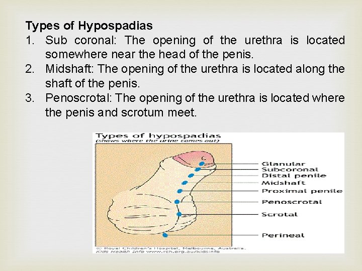 Types of Hypospadias 1. Sub coronal: The opening of the urethra is located somewhere