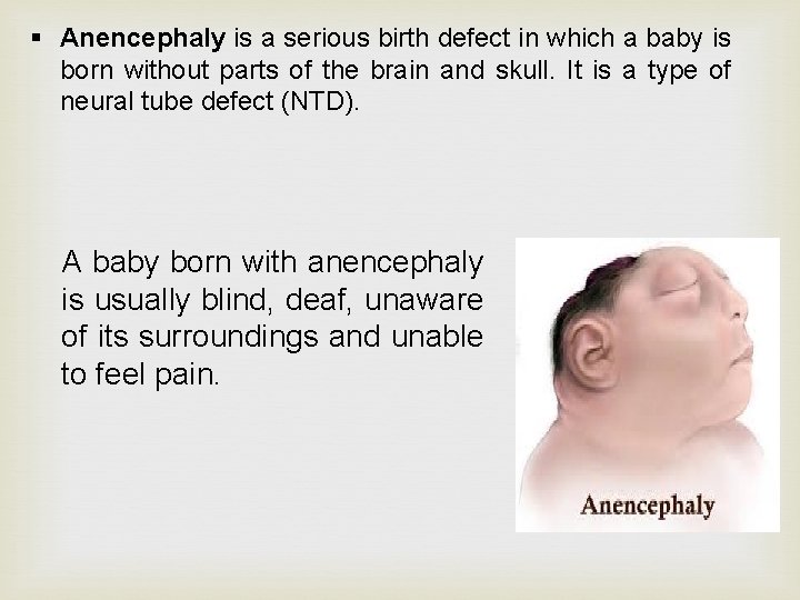 § Anencephaly is a serious birth defect in which a baby is born without