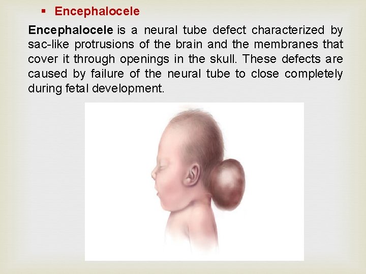§ Encephalocele is a neural tube defect characterized by sac-like protrusions of the brain