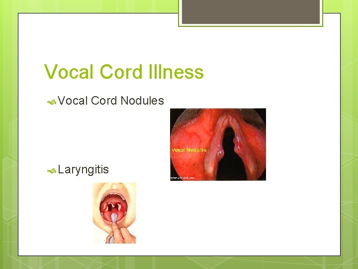 Vocal Cord Illness Vocal Cord Nodules Laryngitis 