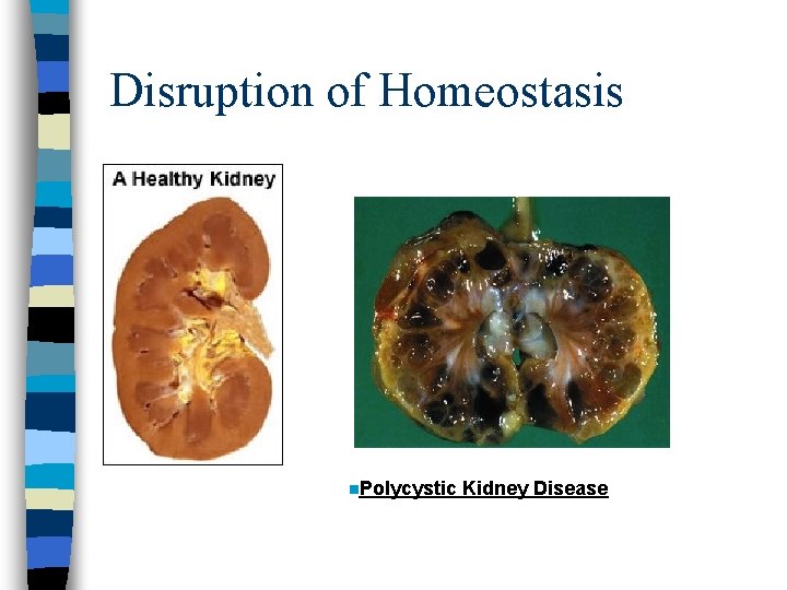Disruption of Homeostasis n. Polycystic Kidney Disease 