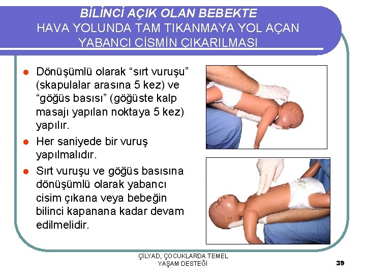 BİLİNCİ AÇIK OLAN BEBEKTE HAVA YOLUNDA TAM TIKANMAYA YOL AÇAN YABANCI CİSMİN ÇIKARILMASI Dönüşümlü