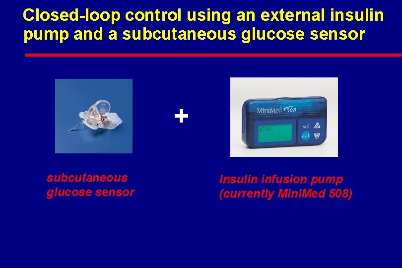 Closed-loop control using an external insulin pump and a subcutaneous glucose sensor + subcutaneous