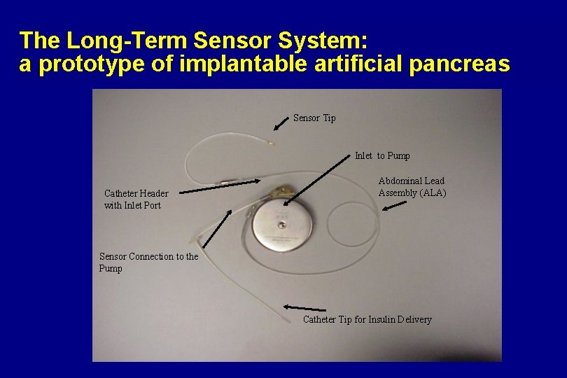 The Long-Term Sensor System: a prototype of implantable artificial pancreas Sensor Tip Inlet to