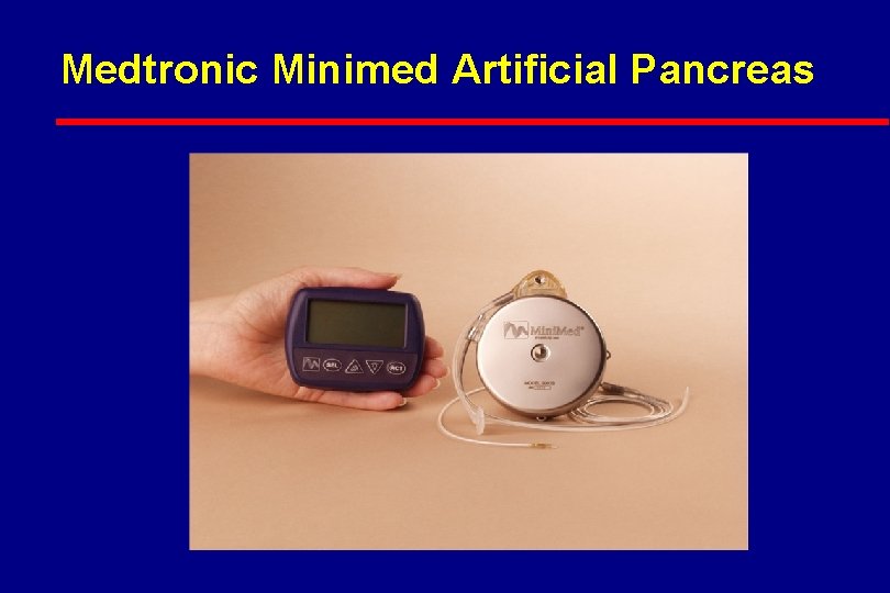 Medtronic Minimed Artificial Pancreas 