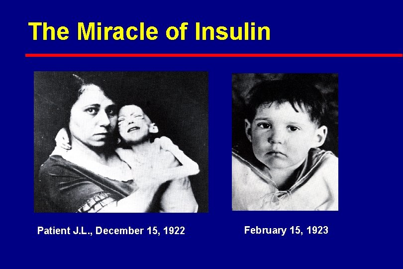 The Miracle of Insulin Patient J. L. , December 15, 1922 February 15, 1923