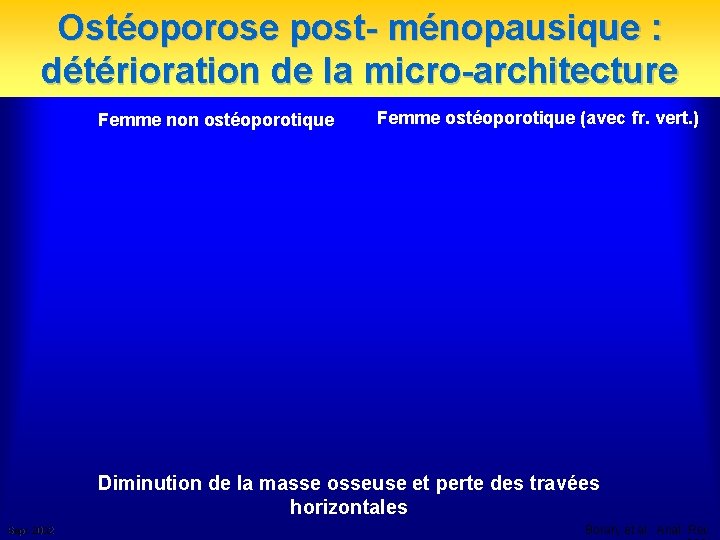 Ostéoporose post- ménopausique : détérioration de la micro-architecture Femme non ostéoporotique Femme ostéoporotique (avec