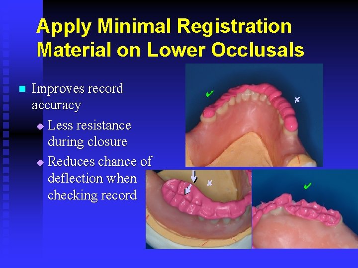 Apply Minimal Registration Material on Lower Occlusals n Improves record accuracy u Less resistance