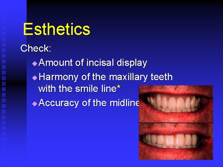 Esthetics Check: u Amount of incisal display u Harmony of the maxillary teeth with