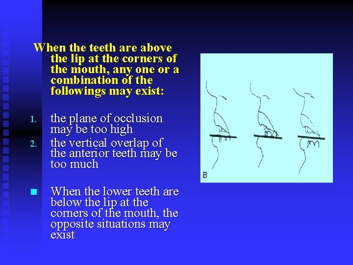 When the teeth are above the lip at the corners of the mouth, any