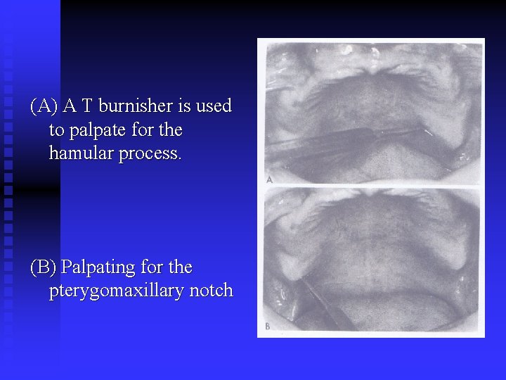 (A) A T burnisher is used to palpate for the hamular process. (B) Palpating