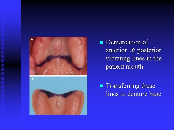 n Demarcation of anterior & posterior vibrating lines in the patient mouth n Transferring